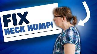 How to Fix Your Neck Hump Fast!