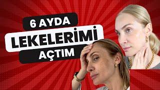 Lekelerimi Azaltıp Nasıl Beyazladım | SO FLY Leke Rutinim Sebile Ölmez