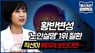 [황반변성] 직선이 휘어져 보인다? '노인 실명' 1위 질환 의심해야