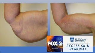 Excess skin removal following weight loss - SLUCare Health Watch