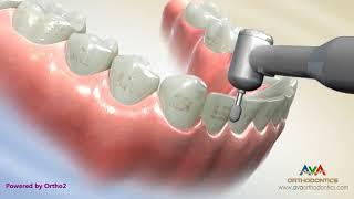 Removing Orthodontic Braces or Debond