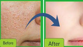 Holistic approach for open pores, blackheads, whiteheads | How To Shrink  Pores