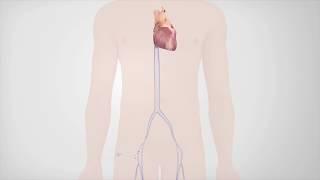 Radiofrequency Catheter Ablation