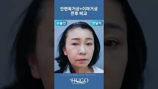 안면거상 & 이마거상 반반 전후비교! 