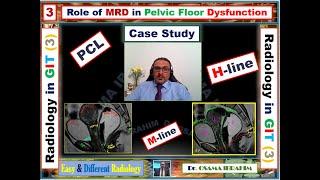 3 MR Defecography ( its role in pelvic floor dysfunction)