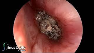 Myiasis of the ear