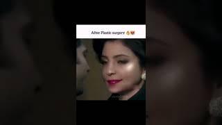 Anushka Sharma Before and After Surgery ||️⭐️||Flicks & FameStatus