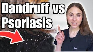 Dandruff Vs Psoriasis? Expert Tips On How To Tell The Difference