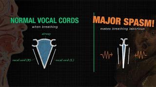 Respiratory Dystonia | When Spasms Affect the Voice