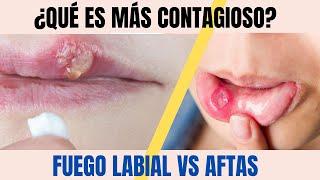 Llagas en la boca ¿Por qué salen y como curarlas?