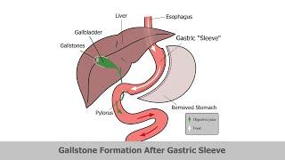 LAPAROSCOPIC CHOLECYSTECTOMY FOLLOWING BARIATRIC SURGERY (POST MGB)