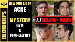 Goodbye Forever ACNE - Pimples Treatment 101 | BeerBiceps Acne & Fitness