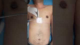 Gynecomastia surgery in delhi | Manboobs Surgery cost