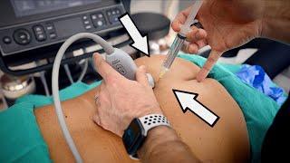 DOCTOR USES ULTRASOUND TO GUIDE HUGE NEEDLES INTO INFLAMEDNERVES (Very Painful) | Dr. Paul
