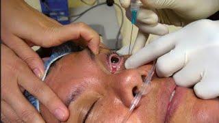 local anaesthesia in to the eye অপারেশন এর আগে চোখ কি ভাবে অবশ্ করে??