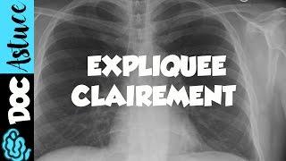  Dr Astuce - 3 ANOMALIES RADIO THORAX EXPLIQUÉES CLAIREMENT ! (PARTIE 1)