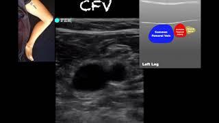 POCUS - Lower Extremity Deep Venous Thrombosis (DVT) - Updated