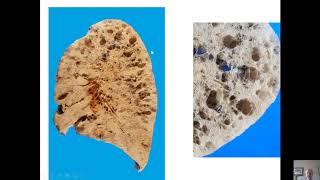 Pathology of Emphysema