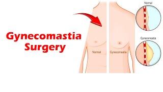 Gynecomastia recovery. 3 Weeks POST-OP Result