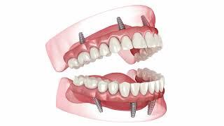 All-On-4 Dental Implants To Replace Missing Teeth | Dental Implants NYC