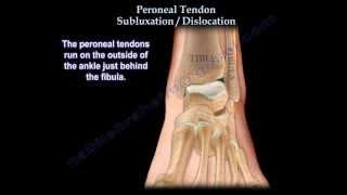 Peroneal Tendon Subluxation / Dislocation - Everything You Need To Know - Dr. Nabil Ebraheim