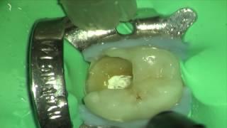 Simple Technique for Pre-Endodontic Restoration