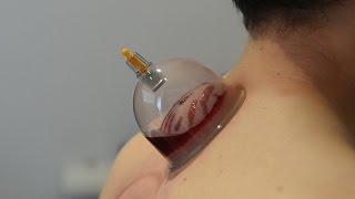 What is Cupping?