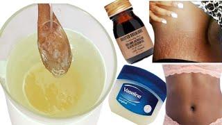 HOW I USE VASELINE AND CASTOR OIL TO CLEAR MY STRETCH MARKS AND VARICOSE VEINS + SPIDER VEINS