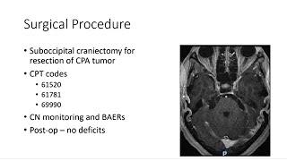 AANS Coding Shorts: Cerebellopontine Angle Tumor Resection