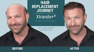 Jeff started losing his hair at 17 | Hair Replacement Journey