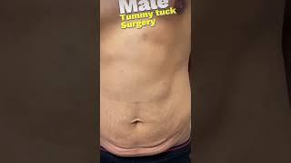 #tummytucksurgery (skonhedsrejsen.com) #shorts #bodybuilding #aesthetic #best #doctor #foryou #vlog