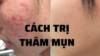 TRỊ THÂM MỤN phải thoa KEM CHỐNG NẮNG | Hàn Ngọc Vân Anh #shorts