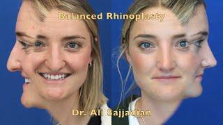 An Amazing Septorhinoplasty by Dr. Ali Sajjadian!| New nose|before&after