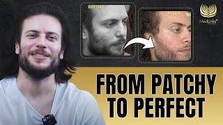 Unbelievable Beard Hair Transplant Results | MedLInks