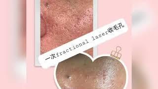 Fractional CO2 laser