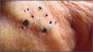 Pimple Popping Blackheads On Skin 