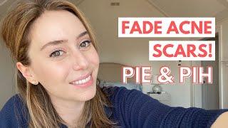 How To Fade Acne Scars: Post Inflammatory Erythema & Post Inflammatory Hyperpigmentation