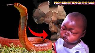 15 Most Terrifying and Painful Snake  Bites In Africa 