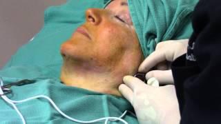 ThermiTight / ThermiRF Treatment for Neck Laxity and Sagging / Radiofrequency (RF) Neck Tightening