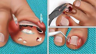 [ASMR Animation] Heals toenails punctured by many sharp objects | Deep Clean Treatment