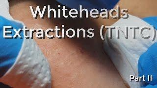 Whiteheads Extraction (TNTC) - Session I - Part 2 of 3