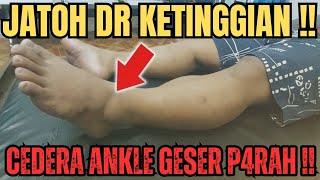 JATOH DARI BANGUNAN TINGGI‼️CEDERA ANKLE GESER PAR4H DISLOK NYA‼️