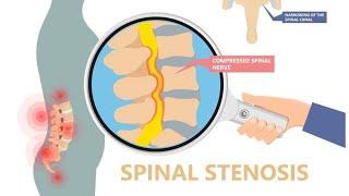 Endoscopic Spine Surgery से Lumbar Canal Stenosis (कमर में दबी हुई नस) का इलाज 