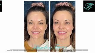 Botox injections in Chandler AZ - Flawless Faces MedSpa Chandler