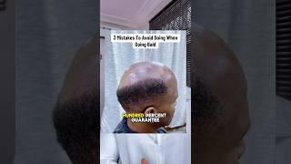 Avoid this mistake when balding #minoxidil #hairlosstreatment