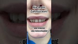 Zahnlücken entfernen! #flowableinjection #schönezähne #hollywoodsmile #veneers