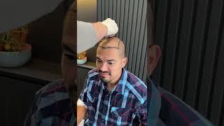 Hair transplant in Turkey  | 10 days after hair transplant #worbimed #hairtransplant