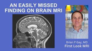 AN EASILY MISSED FINDING ON BRAIN MRI