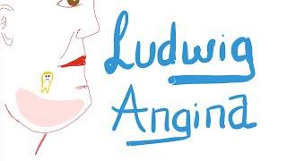 Ludwig Angina |  | Causes, Clinical Picture, Diagnosis and Management