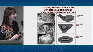 Ультразвуковая диагностика аденомиоза. Есипова И.А.